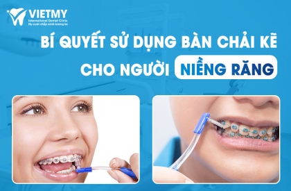 Bí Quyết Sử Dụng Bàn Chải Kẽ Cho Người Đang Niềng Răng Đúng Cách